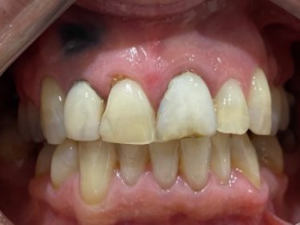 Porcelain Veneers