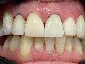 Porcelain Veneers