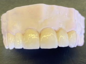 Porcelain Veneers