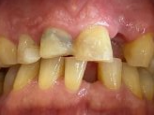 Porcelain Veneers