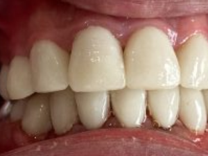 Porcelain Veneers