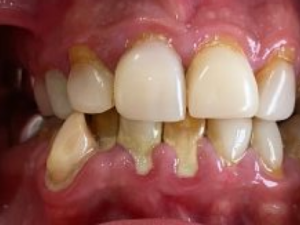 Porcelain Veneers