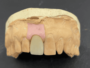 Front Tooth replacement