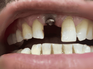 Front Tooth replacement
