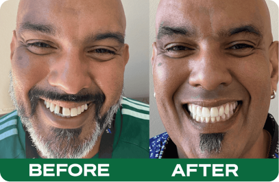 All ON 4 Treatment