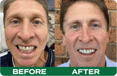 Porcelain Veneers