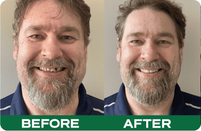 Porcelain Veneers