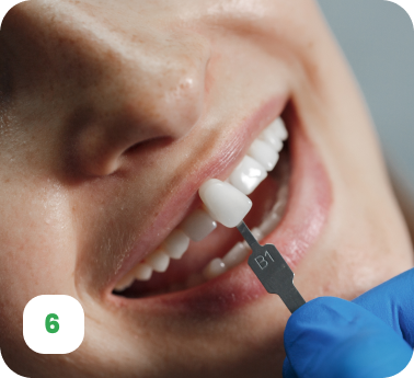 Dental Veneers