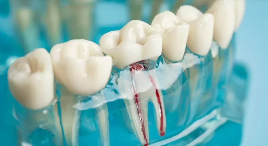 Life After Root Canal