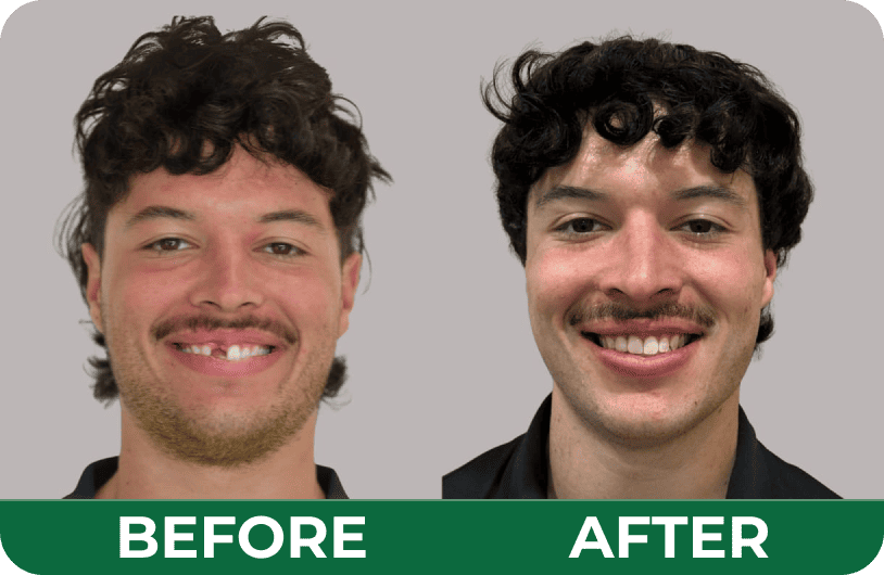 Before and after photos of a male patient’s smile restoration at Dandenong Dental Care.