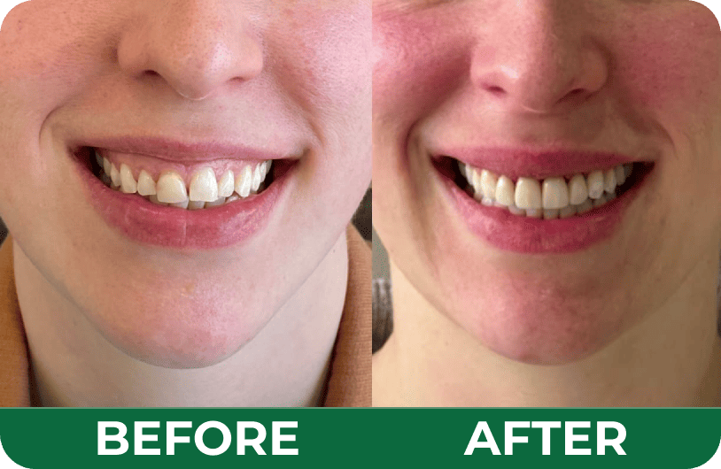 Before and after dental photos of a female patient's gummy smile restoration at Dandenong Dental Care.