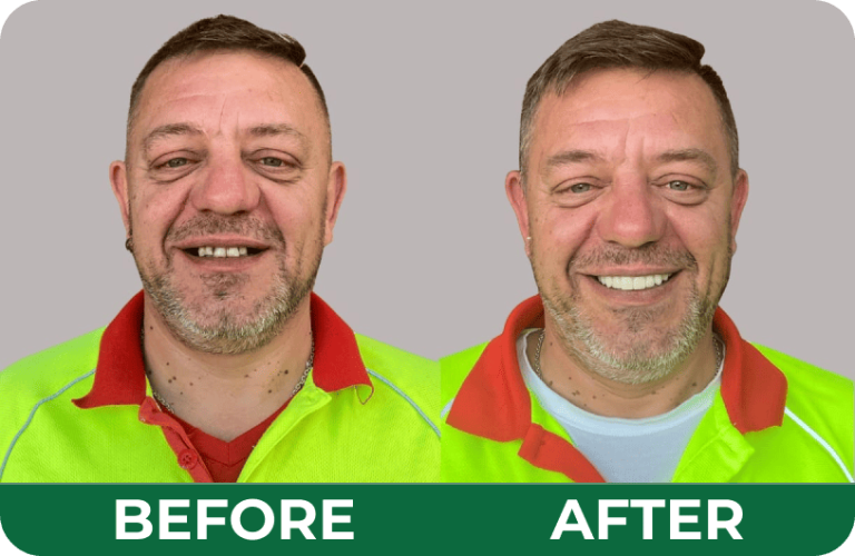 Before and after transformation of a male patient’s smile following restorative treatment at Dandenong Dental Care.