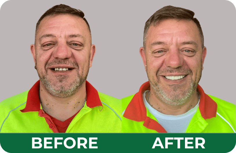 Before and after transformation of a male patient’s smile following restorative treatment at Dandenong Dental Care.