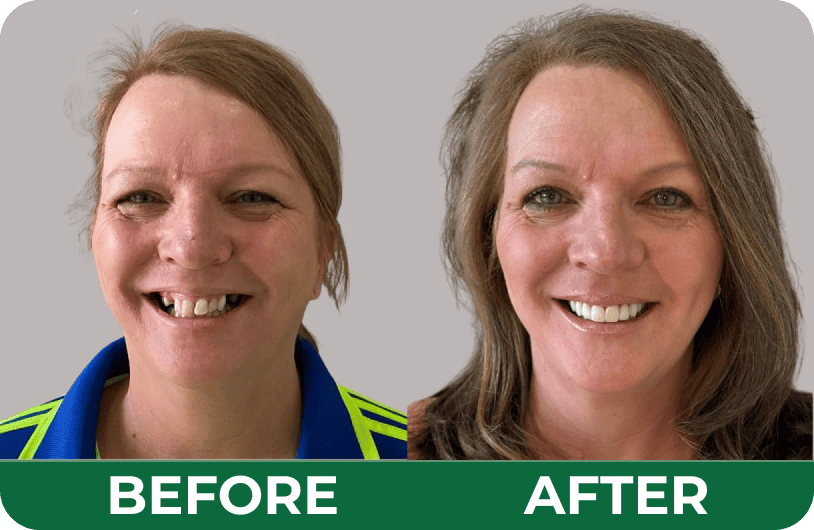 Before and after dental treatment photos of a female patient showcasing a complete smile transformation.