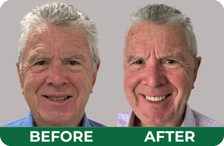 Before and after photos of an elderly male patient’s smile restoration at Dandenong Dental Care.