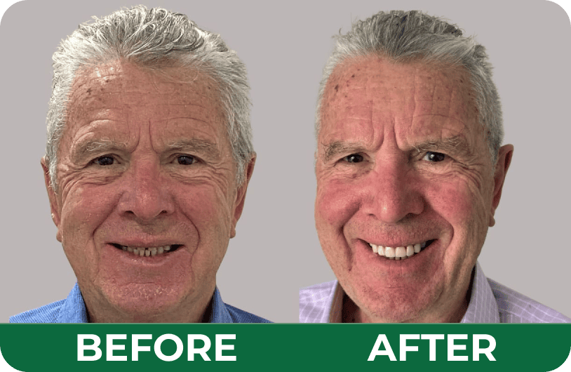Before and after photos of an elderly male patient’s smile restoration at Dandenong Dental Care.