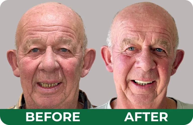 Before-and-After.webp